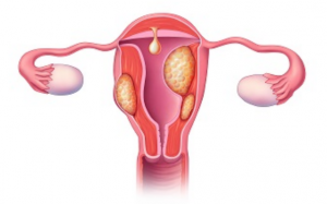 Biến chứng u xơ tử cung và cách cải thiện từ thảo dược