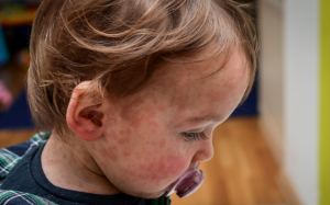 Những kiến thức cần biết trước khi bệnh sởi vào mùa