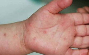 Chủ động phòng bệnh tay chân miệng cho trẻ