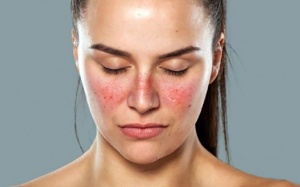 Bệnh lupus ban đỏ sống được bao lâu?