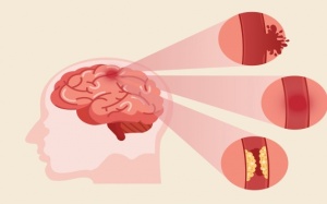 Đột quỵ thoáng qua: Nguyên nhân và cách phòng ngừa