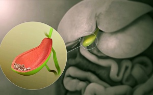 Sỏi túi mật 5mm có nguy hiểm không?