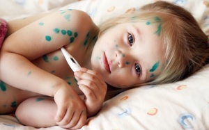 Thủy đậu vào mùa, phòng bệnh cho trẻ thế nào?