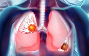 Ung thư phổi giai đoạn cuối: Những điều cần biết