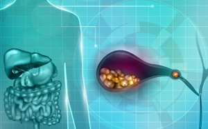 Sỏi mật 25,7mm dùng TPBVSK Kim Đởm Khang được không?