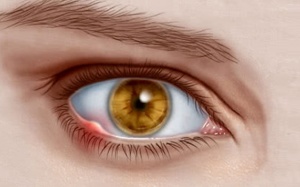 Các cách chữa lẹo mắt tại nhà hiệu quả