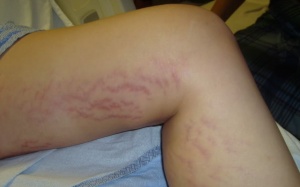 Những sự cố về da do 'mập'