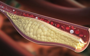 3 bài thuốc nam cải thiện máu nhiễm mỡ hiệu quả 