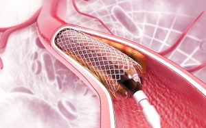 Tắc hẹp mạch vành: Có thể đặt stent nào, chi phí điều trị bao nhiêu?