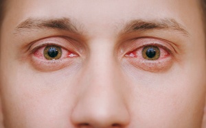 Dị ứng thời tiết gây đau, ngứa mắt, cách xử lý và phòng tránh?