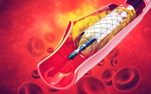 Tắc hẹp mạch vành mức độ nào cần đặt stent?