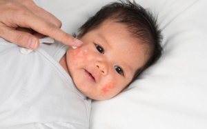 Mụn sữa và chàm sữa ở trẻ phân biệt thế nào?