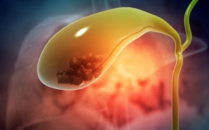 Tổng hợp một số câu hỏi về sỏi túi mật 30mm