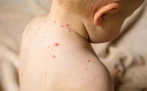 Ca mắc thủy đậu ở Hà Nội gia tăng, phòng bệnh cho trẻ thế nào?