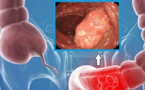 Ung thư ruột kết tăng ở người trẻ, 2 dấu hiệu không thể bỏ qua