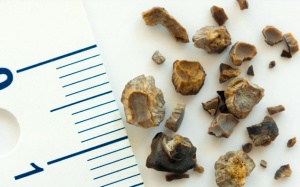 Sỏi mật 20,3mm dùng TPBVSK Kim Đởm Khang được không?