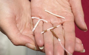 Hy hữu: Vòng tránh thai 'lạc chỗ' đâm thủng đại tràng