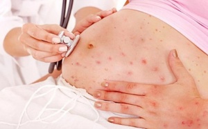 Chuyên gia mách cách phòng thủy đậu ở phụ nữ mang thai