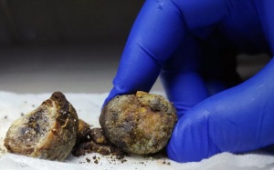 Tổng hợp một số câu hỏi về sỏi mật 2cm