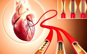 Tắc hẹp mạch vành: Điều trị thế nào trong trường hợp trì hoãn đặt stent?