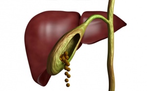 Sỏi túi mật 10,5mm có nguy hiểm không, nên chữa thế nào?