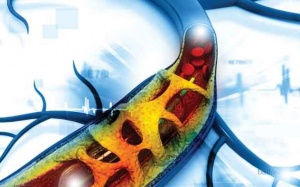 Tại sao tắc hẹp nhiều nhưng không được chỉ định đặt stent?