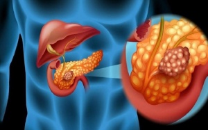 2 triệu chứng ung thư tuyến tụy bạn dễ bỏ qua