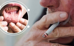 6 dấu hiệu cảnh báo ung thư miệng bạn không nên bỏ qua