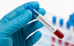 Rủi ro khi cholesterol toàn phần tăng cao
