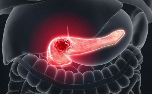 Người đàn ông 38 tuổi mắc ung thư giai đoạn cuối do thói quen xấu