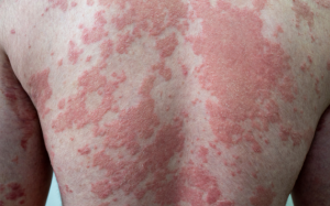 Bị vảy nến đỏ da toàn thân phải làm sao để cải thiện?