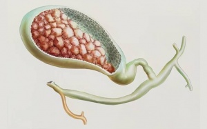 Sỏi túi mật 15mm có nguy hiểm không?