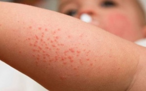 Trẻ nổi mẩn ngứa khi trời nắng nóng, cha mẹ xử lý thế nào?