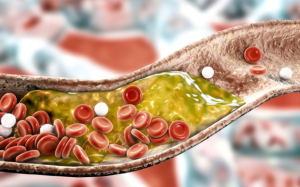 Những biến chứng nguy hiểm khi mắc bệnh mỡ máu cao