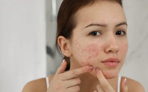 Điểm mặt những nguyên nhân gây mụn