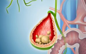Một vài câu hỏi thường gặp về sỏi mật 3cm