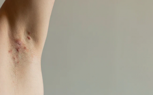 Cách loại bỏ mụn nhọt dưới cánh tay tại nhà