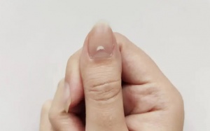 Móng tay có đốm trắng nói lên điều gì về sức khỏe?