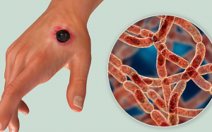 Tăng cường công tác phòng, chống dịch bệnh than trên người