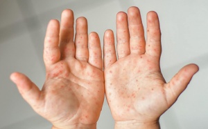 Nhiều trẻ mắc tay chân miệng trở nặng, nguy cơ thiếu thuốc đặc trị