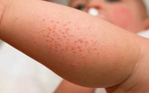 Cách chăm sóc và phòng ngừa rôm sảy cho trẻ