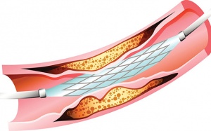 Nên làm gì để trì hoãn việc đặt lại stent động mạch vành?