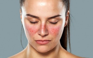 Không nên chủ quan với bệnh lupus ban đỏ
