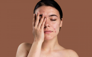 3 sai lầm làm tăng các đốm đen trên da