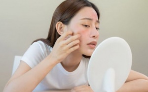 Những lưu ý khi chăm sóc da nhạy cảm trong mùa Hè