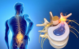 Thoát vị đĩa đệm: Mức độ nguy hiểm và cách điều trị hiện nay