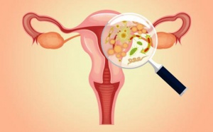 Phát hiện vi khuẩn có thể kích thích lạc nội mạc tử cung