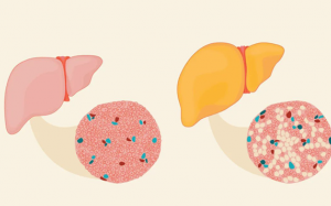 Tỷ lệ người mắc bệnh gan nhiễm mỡ không do rượu tăng cao