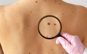 Những điều cần biết về ung thư hắc tố