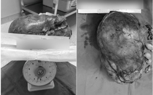 Người đàn ông phát hiện khối u tăng 5,5kg chỉ sau 5 tháng